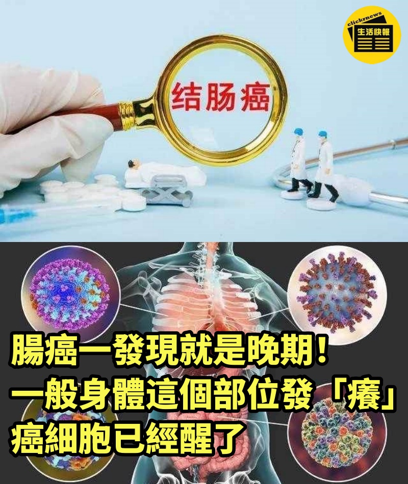 腸癌一發現就是晚期！一般身體這個部位發「癢」：癌細胞已經醒了